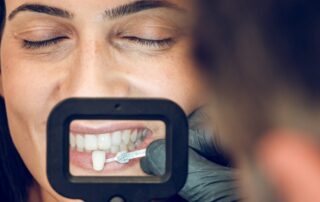 veneers