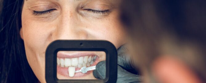 veneers