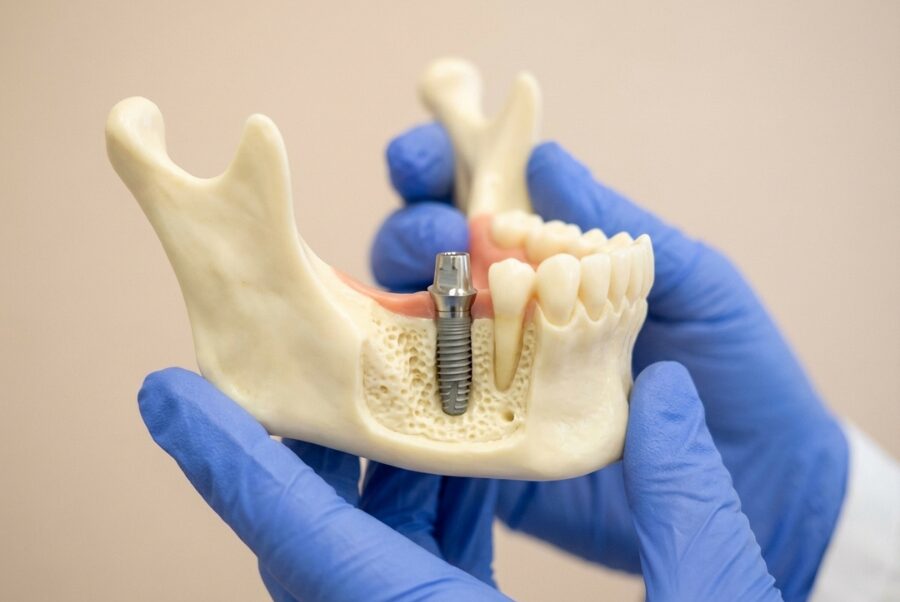 jawbone preparation dental implant procedure Woodbridge VA bone graft model